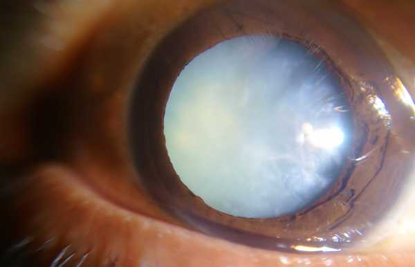 Causes of Cataract
