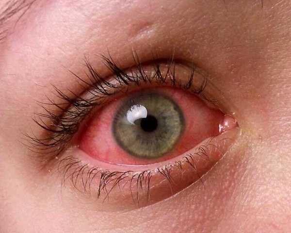 اسباب احمرار العين | التهاب الملتحمة الفيروسي | حساسية العين | عيادة د ...