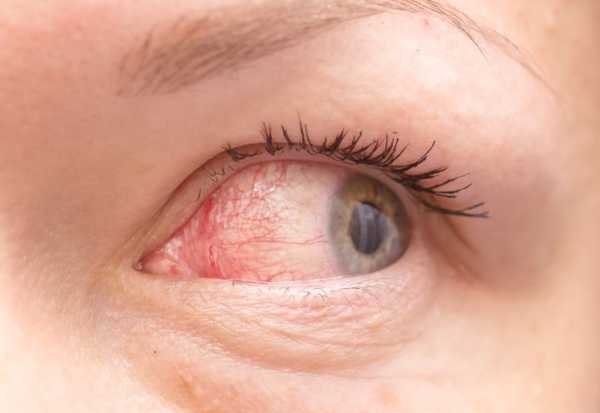 علاج احمرار العين