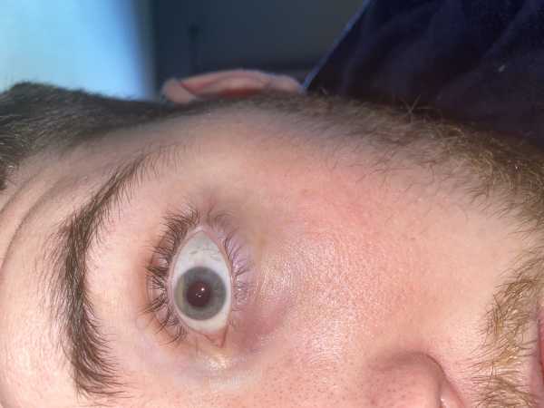 Picture of the eye which has silicone oil inserted in. See top of eye.