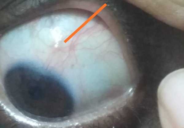 Nodule and redness on upper white part in left eye