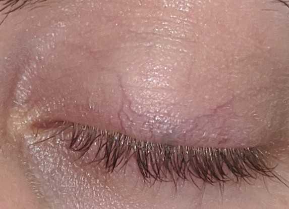 Picture of the spot on eyelid.