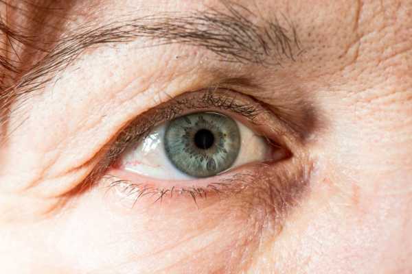 Dermatochalasis or baggy eyelid