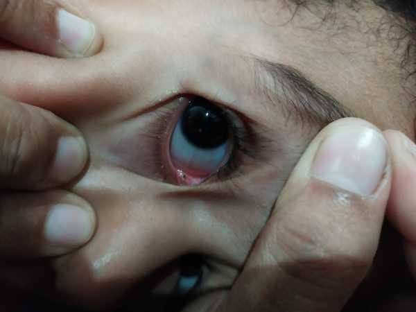 Black dot in the Eyelid-2