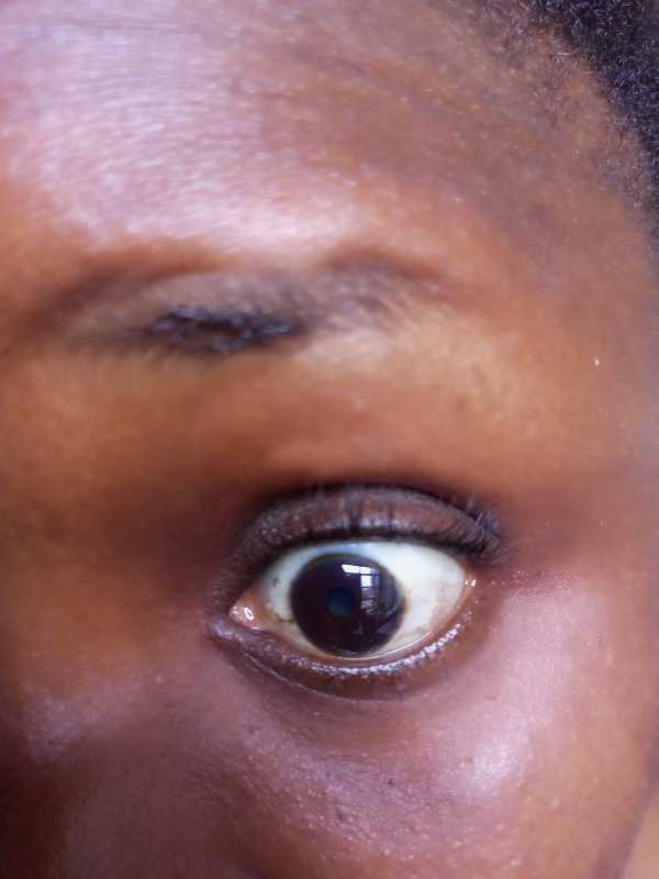 Eye discoloration, pain and pressure-2