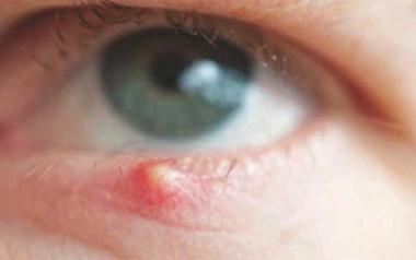 How to Prevent Stye formation