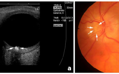 Optic disc drusens in normal fundus examination and B scan. It appears as calcified plate in B-Scan