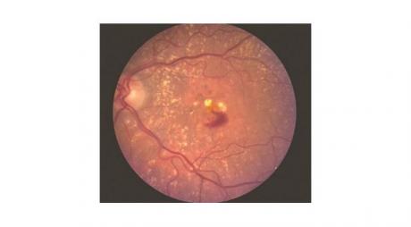 Definition of Age Related Macular Degeneration. Wet Age Related Macular Degeneration with Choroidal Neovascularization, blood and exudates at the macula © 2019 American Academy of ophthalmology