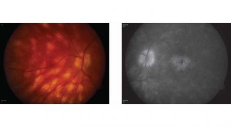 Birdshot Chorioretinopathy. Multiple subretinal white spots that radiate from optic disc© 2019 American Academy of Ophthalmology