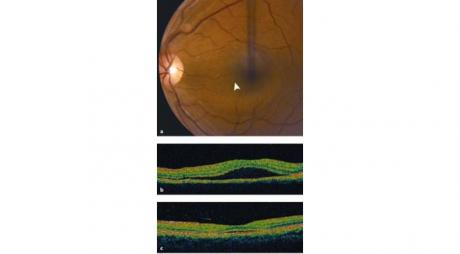 Central Serous Retinopathy or Central serous choroidopathy is characterized by detachment of neurosensory layers of the retina © 2019 American Academy of Ophthalmology