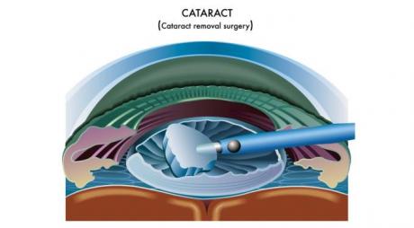 Common Symptoms After Cataract Surgery