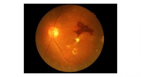 Complications of Diabetic Retinopathy. Macular exudates and hemorrhage