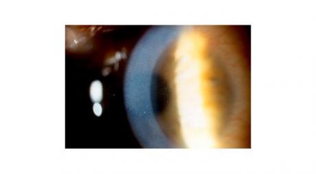 Diffuse Lamellar Keratitis with mild central corneal Haziness. It is one of the lasik eye surgery complication© 2019 American Academy of ophthalmology