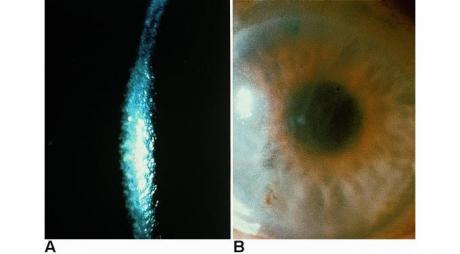 Fuchs Endothelial Dystrophy. Corneal edema in patients with Fuchs Endothelial Dystrophy © 2019 American Academy of Ophthalmology