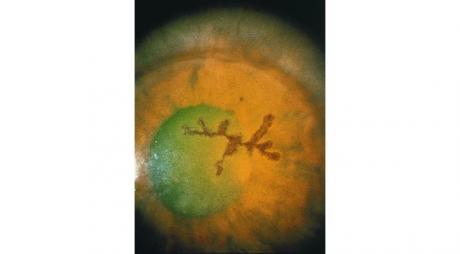 Herpes Eye Infections. Rose bengal stain shows epithelial dendritic ulcer due to herpes eye infection© 2019 American Academy of Ophthalmology