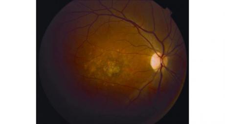 Macular Dystrophy in Stargardt Disease © 2019 American Academy of Ophthalmology