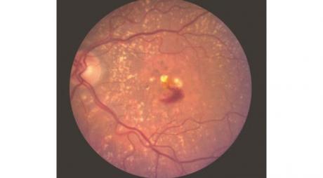 Modified Vitamin A and Macular Degeneration. Blood and exudate due to choroidal neovascularization © 2019 American Academy of Ophthalmology