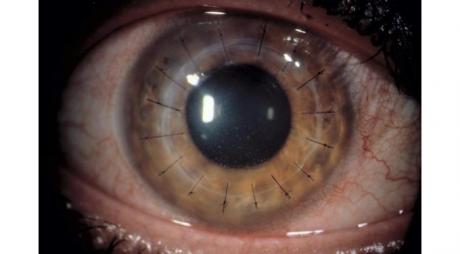 New therapy for improving Corneal Graft Survival in Corneal Transplant rejection © 2019 American Academy of Ophthalmology 