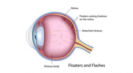 Pathological Causes Of Eye Floaters