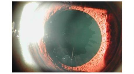 Pseudoexfoliation Glaucoma with Dandroff whitish like material deposits on the anterior capsule of the lens
