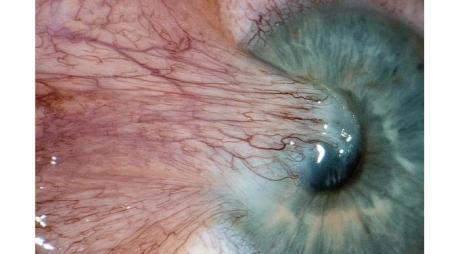 Pterygium Removal. This large recurrent pterygium occurred after surgical pterygium removal © 2019 American Academy of Ophthalmology