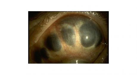 Scleromalacia Perforans with thinning of white sclera and herniation of the underlying dark choroid.© 2019 American Academy of Ophthalmology
