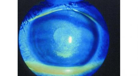 Signs of Dry Eyes. Fluorescein stain of the cornea with corneal epithelial abrasion due to dry eye © 2019 American Academy of Ophthalmology