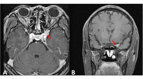 Tolosa Hunt Syndrome is a rare idiopathic, non specific granulomatous inflammation of the cavernous sinus and/or superior orbital fissure