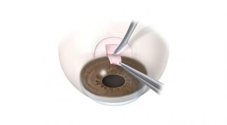Trabeculectomy Surgery for Glaucoma