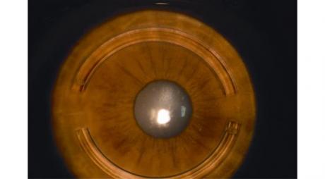 Treatment of Keratoconus with corneal rings © 2019 American Academy of Ophthalmology