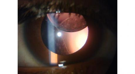 Weill Marchesani Syndrome. Subluxated lens superiorly or cataract in Weill Marchesani Syndrome © 2019 American Academy of Ophthalmology
