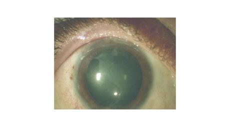 اصابات العين الكيميائية