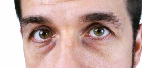 اسباب الهالات السوداء حول العين