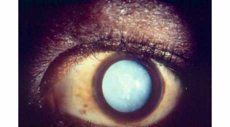 مضاعفات عملية المياه البيضاء في العين