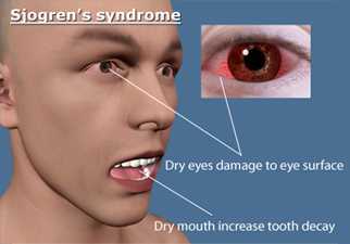 Sjogrens Disease with dry eyes and dry mouth