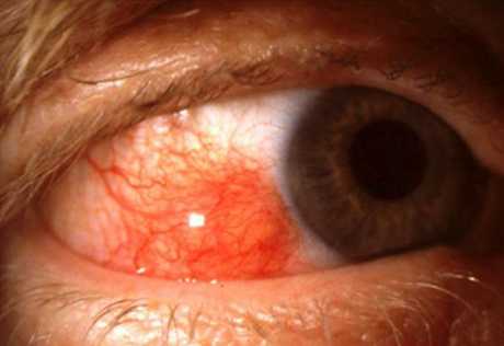 Nodular Scleritis. Redness of the episcleral and scleral layer of the eye with formation of pink to red nodules