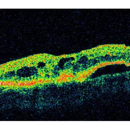 Topical Anti-VEGF Eye Drops. Optical Coherence Tomography of CNV © 2019 American Academy of Ophthalmology