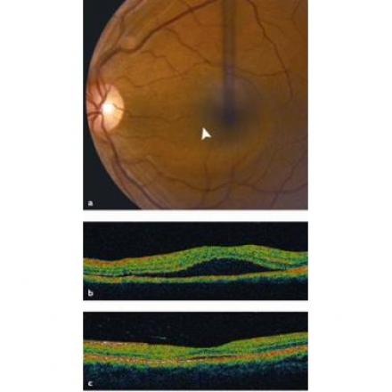Central Serous Retinopathy or Central serous choroidopathy is characterized by detachment of neurosensory layers of the retina © 2019 American Academy of Ophthalmology