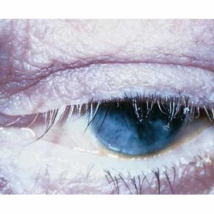 Complications of Blepharitis. Madarosis and Poliosis of the eyelashes due to chronic inflammation in blepharitis.© 2019 American Academy of Ophthalmology
