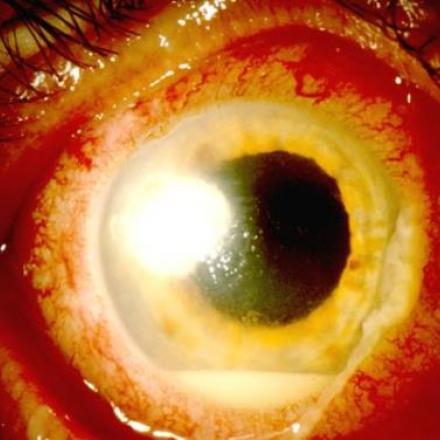 Contact Lens Associated Keratitis. Corneal edema with hypopyon in the anterior chamber © 2019 American Academy of Ophthalmology