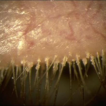 Definition of Blepharitis © 2016 American Academy of Ophthalmology 