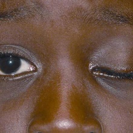 Definition of Ptosis. This patient with left eye ptosis.© 2019 American Academy of Ophthalmology