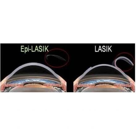 Epi Lasik and Lasek Eye Surgery
