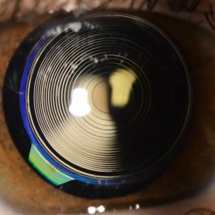 Intraocular Lens for Presbyopia. Multifocal IOL