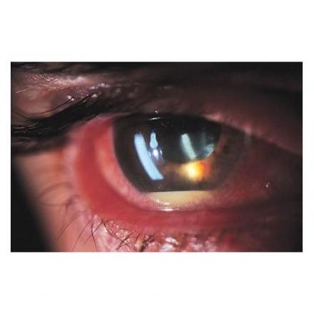 Iridocyclitis with hypopyon and red eye
