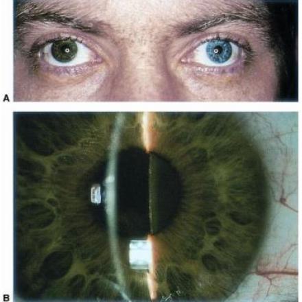 Iris Heterochromia. A- Heterochromia in patients with siderosis bulbi. B- Brownish discoloration of anterior lens capsule and lens due to deposition