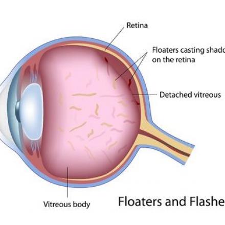 Pathological Causes Of Eye Floaters
