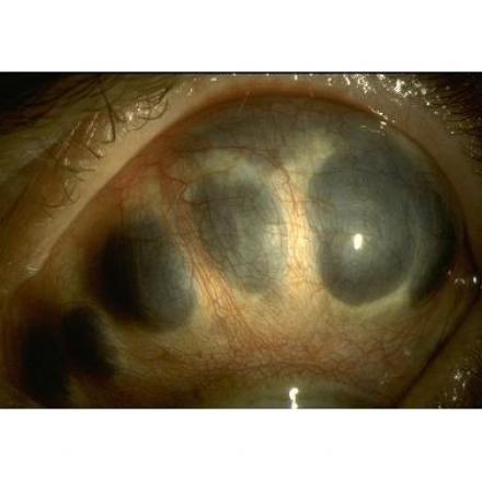 Scleromalacia Perforans with thinning of white sclera and herniation of the underlying dark choroid.© 2019 American Academy of Ophthalmology