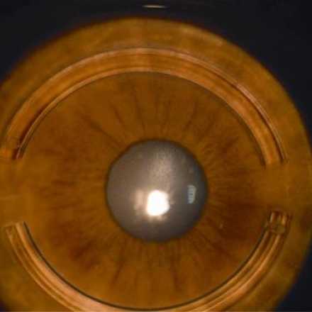 Treatment of Keratoconus with corneal rings © 2019 American Academy of Ophthalmology