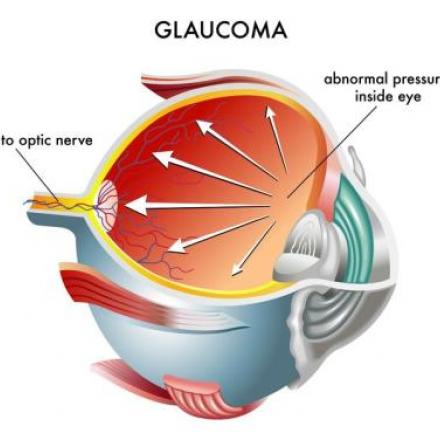 Treatments of Glaucoma
